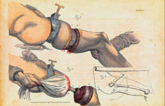 Illustration of a leg amputation by Sir Charles Bell, from the Edinburgh Surgeon's Hall Museum